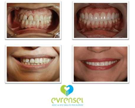 Slider image (6) Evrensel Dental Clinic in Ankara Turkey
